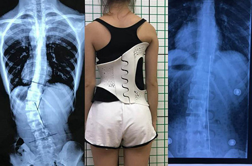 3D打印技術在骨科的實際應用有哪些？(圖4)